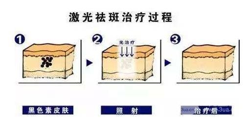 西京医院激光祛斑价目表2020版 费用解析大全~ 