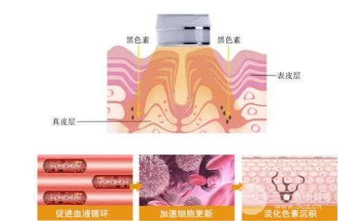 光子嫩肤哪家医院好 谨记这几点很重要~