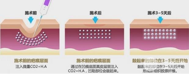 郑大一附院祛疤技术