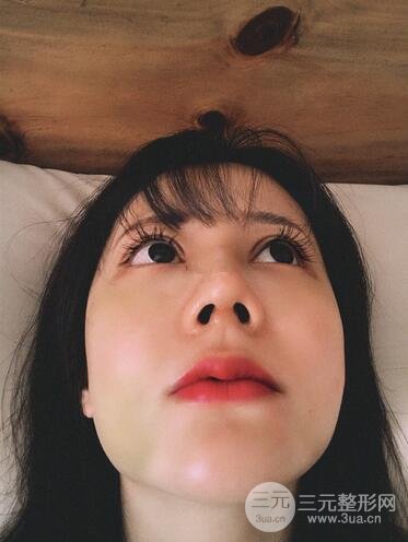 【攻略】301郭伶俐鼻整形怎么样 效果图放送