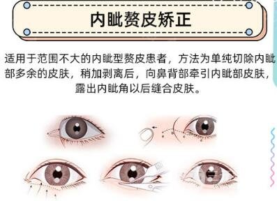 做开眼角手术多少钱?贫民窟女孩也能HOLD住