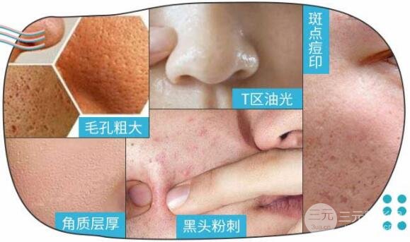 像素激光祛痘要做几次！别让前功尽弃！