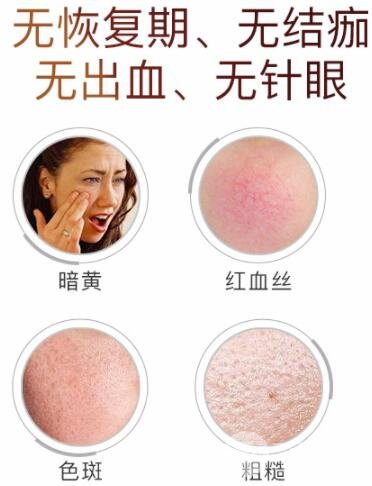 医美小课堂:白瓷娃娃激光功及果图