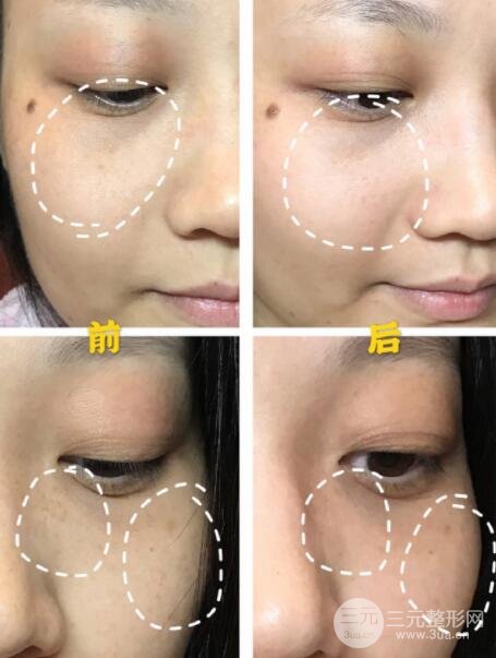 白瓷娃娃激光功及果图