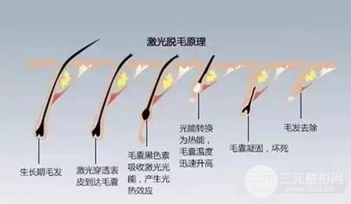 激光脱毛价格