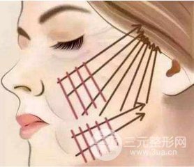 不到30岁可以做埋线面部除皱吗?注意事项有哪些?