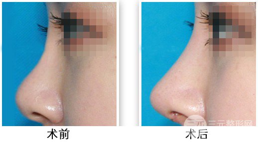 假体隆鼻注意事项有哪些呢?赶紧来科普一下吧~