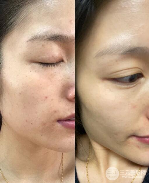 #医美科普#黑脸娃娃手术价格&果全攻略