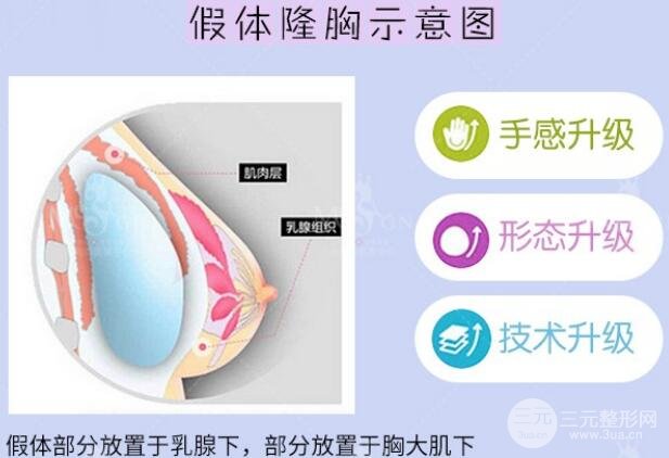 娜绮丽隆胸