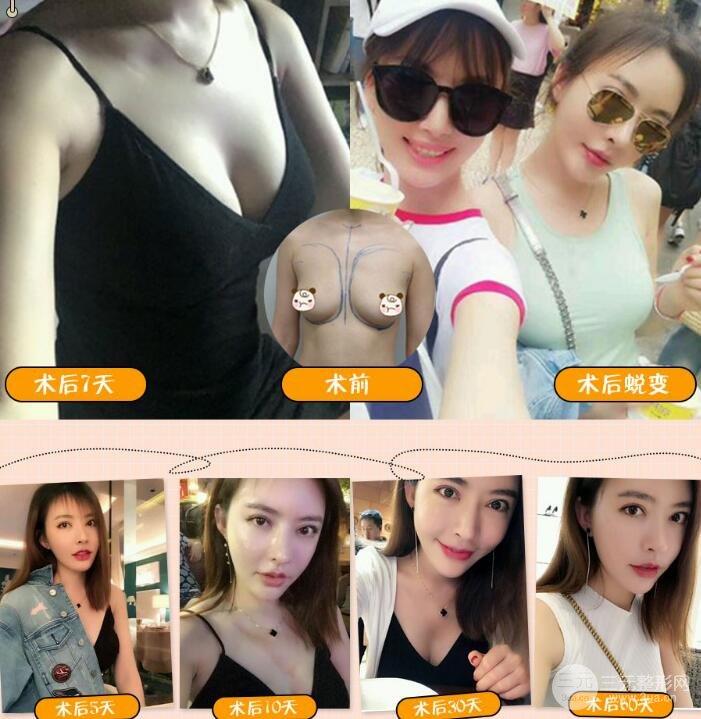 娜绮丽隆胸案例