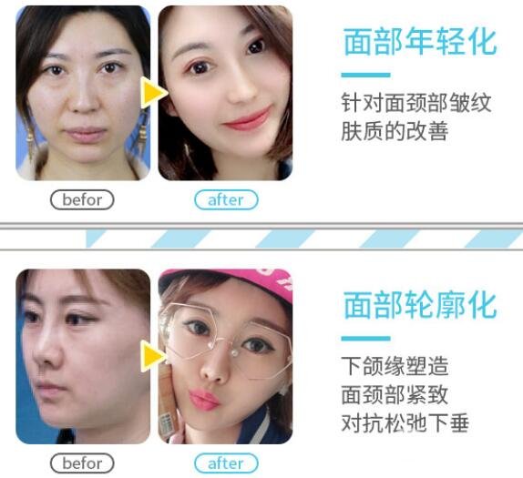 不到30岁,可以做热玛吉紧肤吗?会加重皮肤衰老吗?