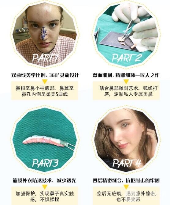 硅胶隆鼻成好吗？传统假体果也很ok~