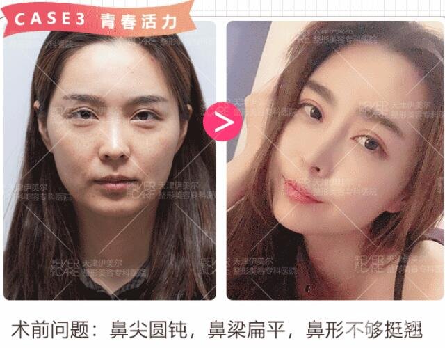 硅胶隆鼻果图