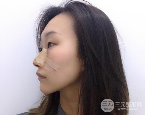 中山大学附属第一医院整形外科隆鼻案例，术后真实反馈~