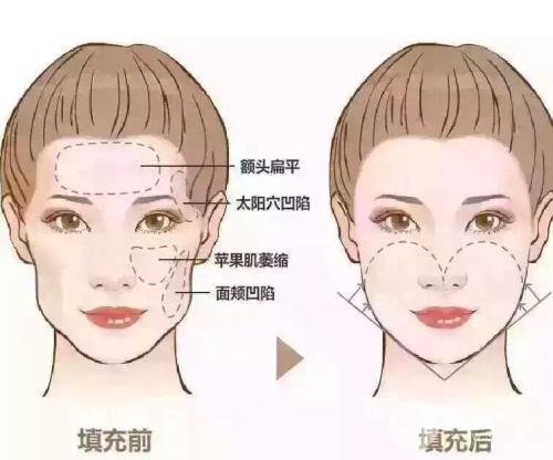 玻尿酸丰面颊多少钱？挥别凹陷，还你年轻脸蛋~