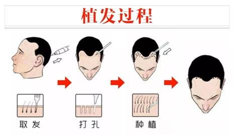 植发手术原理解析