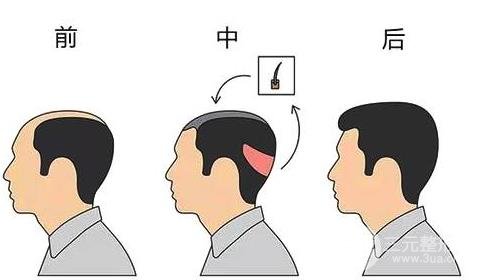 植发手术原理解析