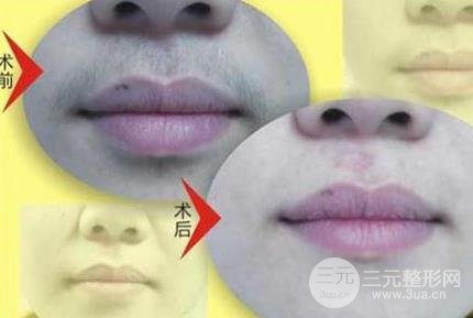 面部激光脱毛手术以后注意事项