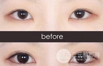 开外眼角手术前的注意事项