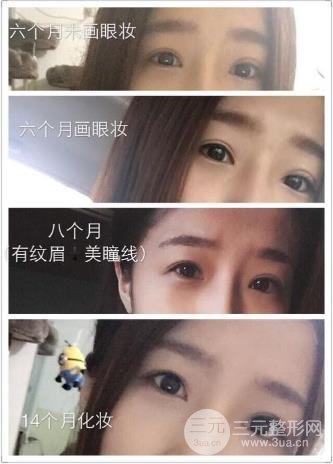开外眼角手术前的注意事项