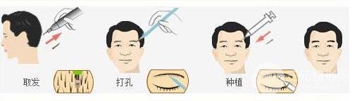 种植眉毛多少钱?