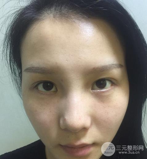 北京301医院整形科好不好？双眼皮案例给你答案！