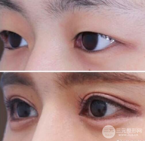 重庆西南医院整形科双眼皮案例图
