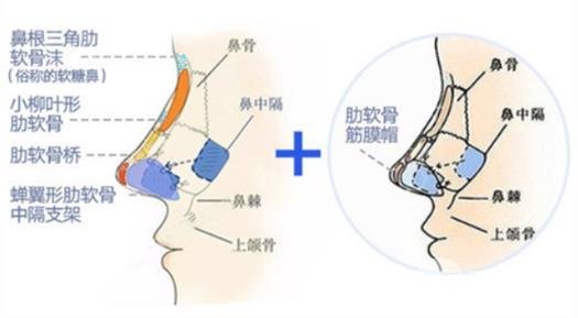 鼻子整形手术后的注意事项