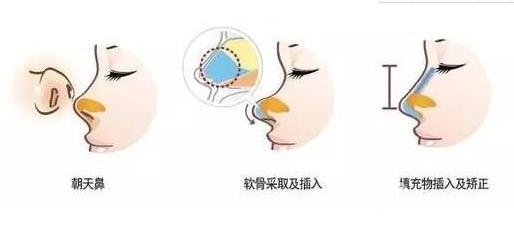 朝天鼻矫正要多少钱？