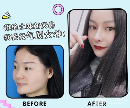 鼻头缩小术前注意事项