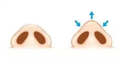鼻头缩小术需要多少钱？