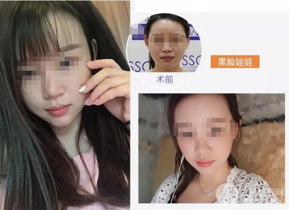 做黑脸娃娃后的注意事项