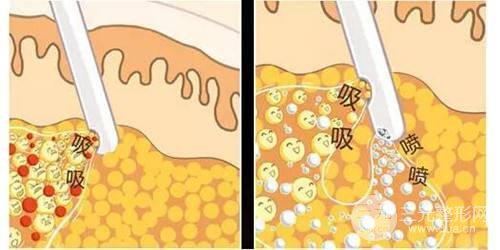 面部吸脂整形多久恢复自然？科普一下吧~