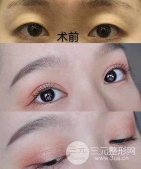 割双眼皮对比图,光看这些图片就能感受到手术的优势