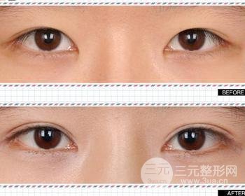 割双眼皮对比图,光看这些图片就能感受到手术的优势