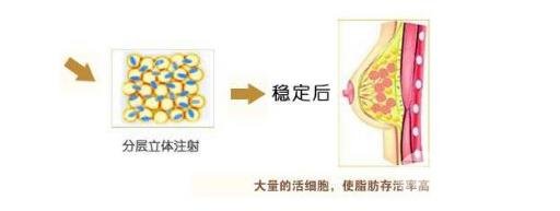 自体脂肪移植隆胸费用