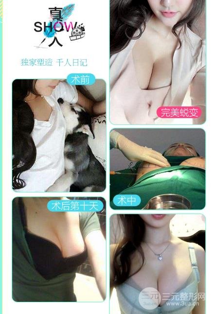 体脂肪移植隆胸前注意事项