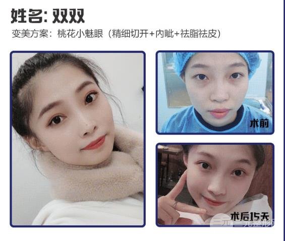专业双眼皮手术后注意事项