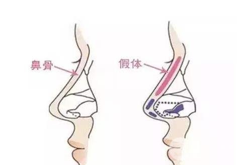 假体隆鼻怎么样?