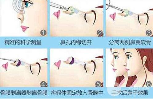 假体隆鼻怎么样?