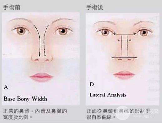 鼻骨缩小的方法