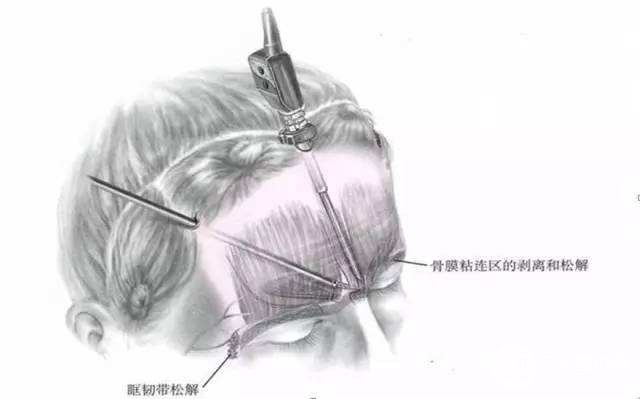所谓内窥镜除皱,原来是这样的一个技术~