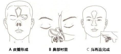 #医美小科普#鼻子再造手术的难度高吗?
