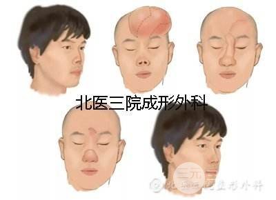 #医美小科普#鼻子再造手术的难度高吗?