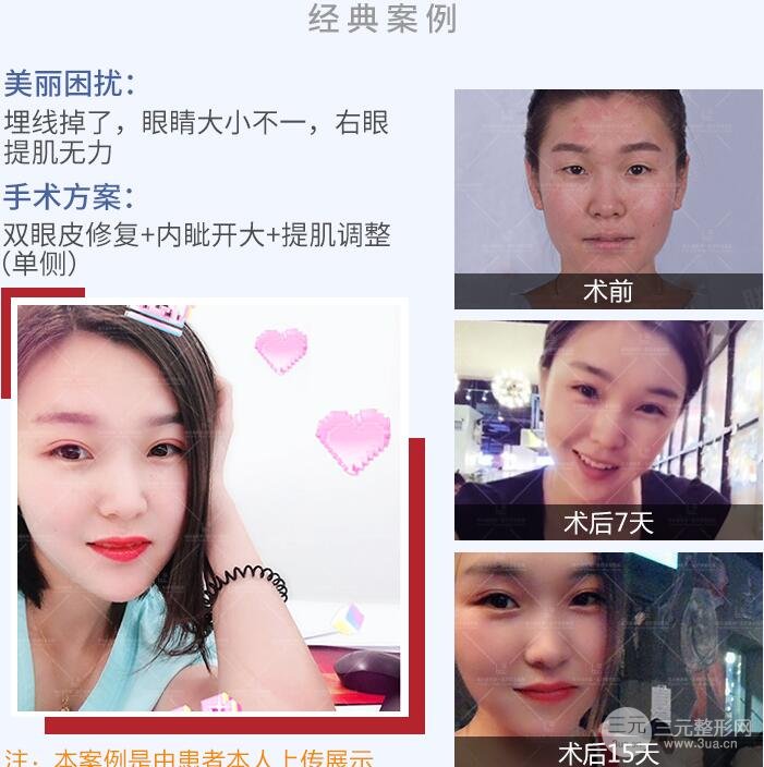 双眼皮修复案例