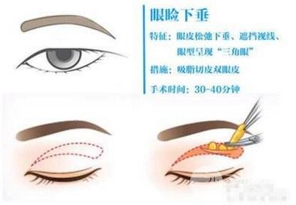 介绍一下眼部提升手术，看你适合做吗？