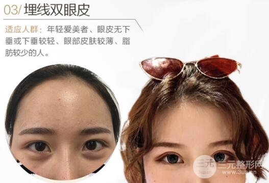 爱美小仙女10问:埋线法双眼皮多少钱?
