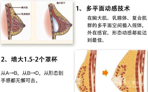 遇到这几种情况，隆胸修复手术你肯定是要做的了！