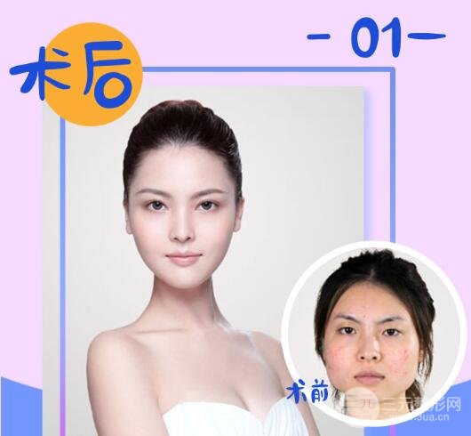 打注射瘦脸后注意事项