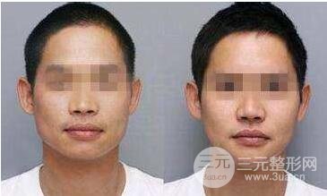 脸针之前注意的事情
